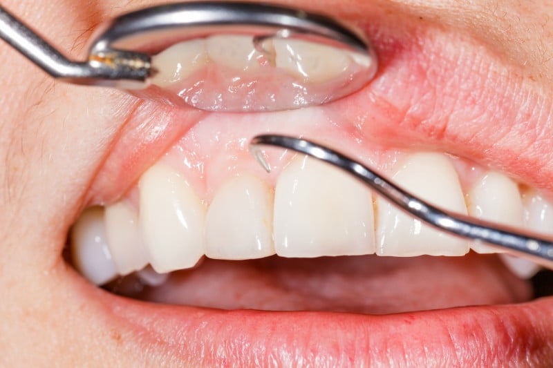 doenças periodontais Saúde Oral
