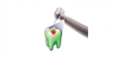 Dentaleader lança acoplamento Fluoresce HD