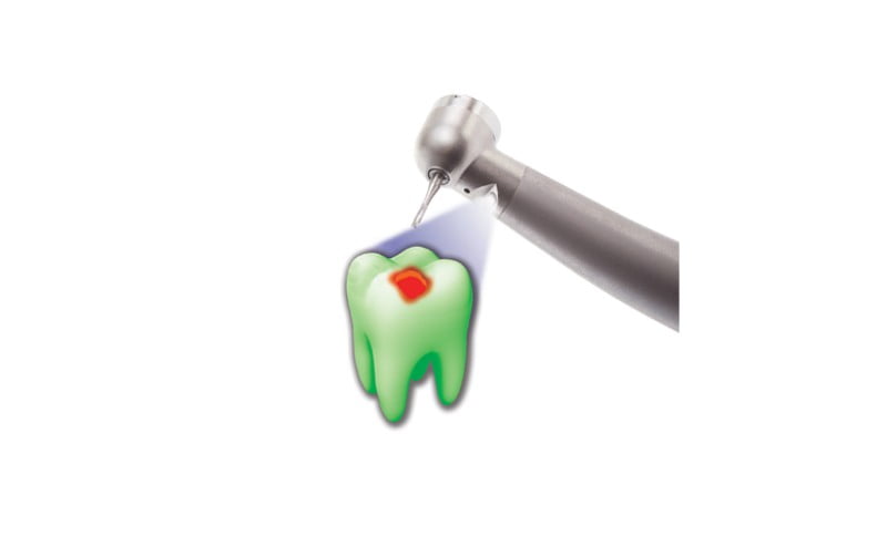 Dentaleader lança acoplamento Fluoresce HD