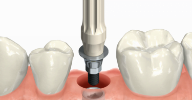 Nobel Biocare cria solução para preservação de tecidos