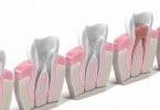 Materiais biocerâmicos: Qual o impacto nos tratamentos endodônticos?