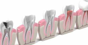 Materiais biocerâmicos: Qual o impacto nos tratamentos endodônticos?