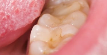 Formação de aftas orais semelhante à ‘Guerra dos Tronos’