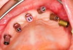 Curso avançado de cirurgia e implantologia oral