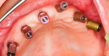 Curso avançado de cirurgia e implantologia oral