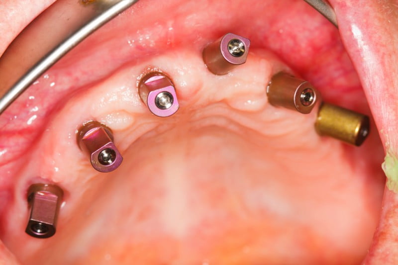 Curso avançado de cirurgia e implantologia oral