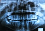 Radiografias dentárias podem revelar deficiência de Vitamina D