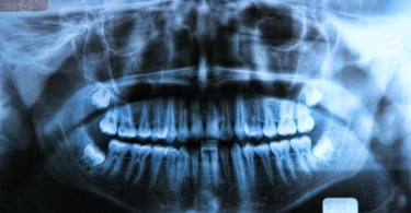 Radiografias dentárias podem revelar deficiência de Vitamina D