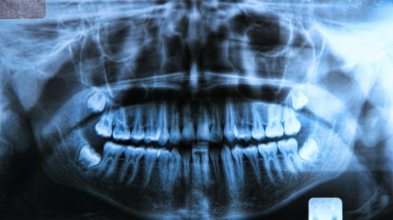 Radiografias dentárias podem revelar deficiência de Vitamina D