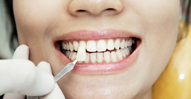 Dismorfia dentária afeta cada vez mais pessoas
