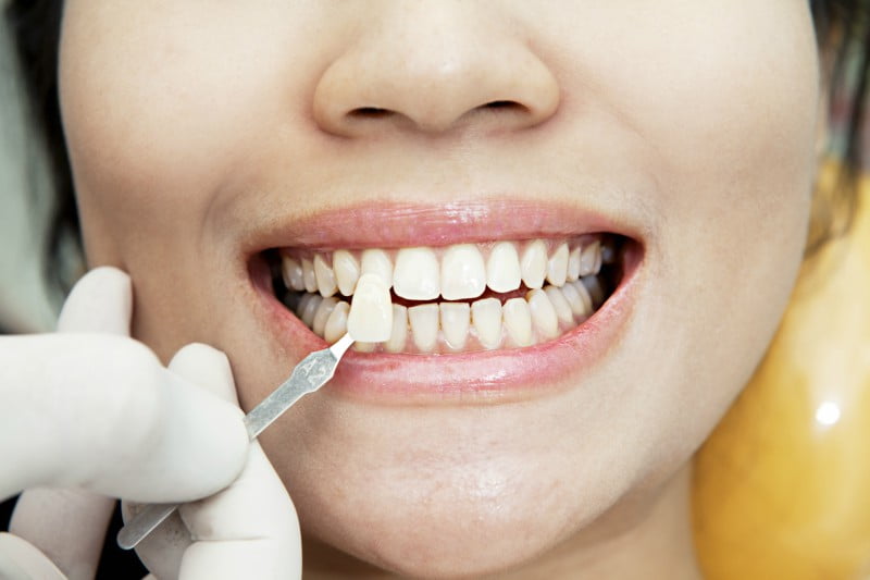 Dismorfia dentária afeta cada vez mais pessoas