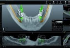 Zirkonzahn.Implant-Planner promete alargar colaboração entre laboratório e consultório