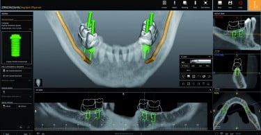 Zirkonzahn.Implant-Planner promete alargar colaboração entre laboratório e consultório
