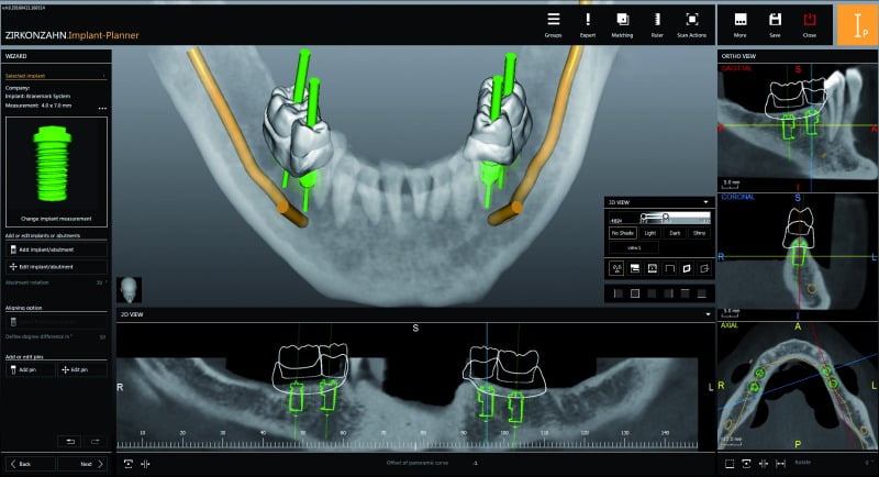 Zirkonzahn.Implant-Planner promete alargar colaboração entre laboratório e consultório
