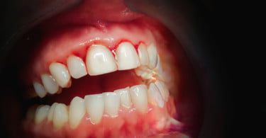 Instituto Iron realiza formação de ‘Recobrimento Periodontal e Peri-implantar’