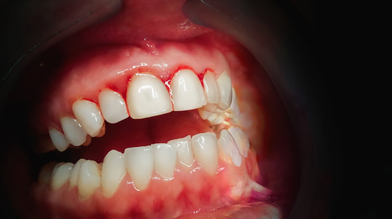 Instituto Iron realiza formação de ‘Recobrimento Periodontal e Peri-implantar’
