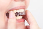Investigadores desenvolvem revestimento que previne crescimento de bactérias em aparelhos dentários