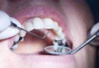 Utilização da amálgama dentária: restrições entram em vigor