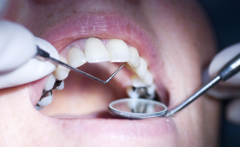 Utilização da amálgama dentária: restrições entram em vigor