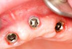 Combater bactérias de implantes dentários com nanotecnologia