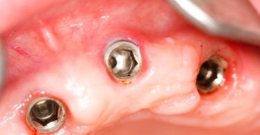 Combater bactérias de implantes dentários com nanotecnologia