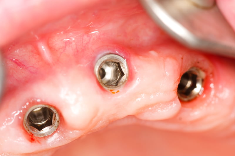 Combater bactérias de implantes dentários com nanotecnologia