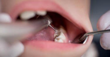 Associação Dentária Australiana cria novos standards de esterilização de dispositivos médicos reutilizáveis