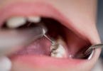 cáries dentárias Saúde Oral