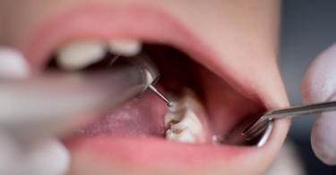 cáries dentárias Saúde Oral