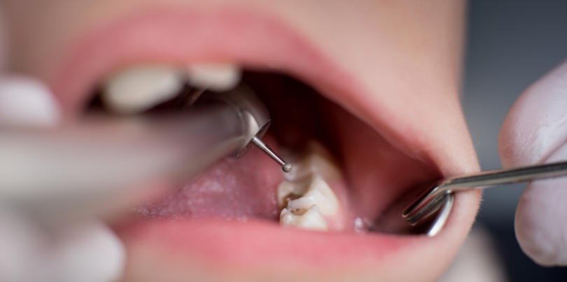 cáries dentárias Saúde Oral