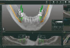 Zirkonzahn apresenta Implant-Planner