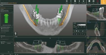 Zirkonzahn apresenta Implant-Planner