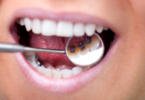 Tratamento ortodôntico não é garantia de uma boa saúde oral a longo prazo