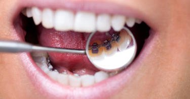Tratamento ortodôntico não é garantia de uma boa saúde oral a longo prazo