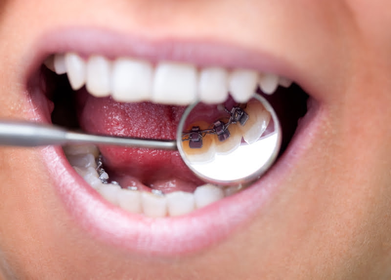 Tratamento ortodôntico não é garantia de uma boa saúde oral a longo prazo