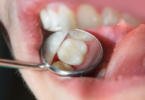 Facetas de porcelana: conhece os prós e contras?