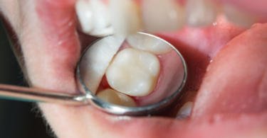 Facetas de porcelana: conhece os prós e contras?