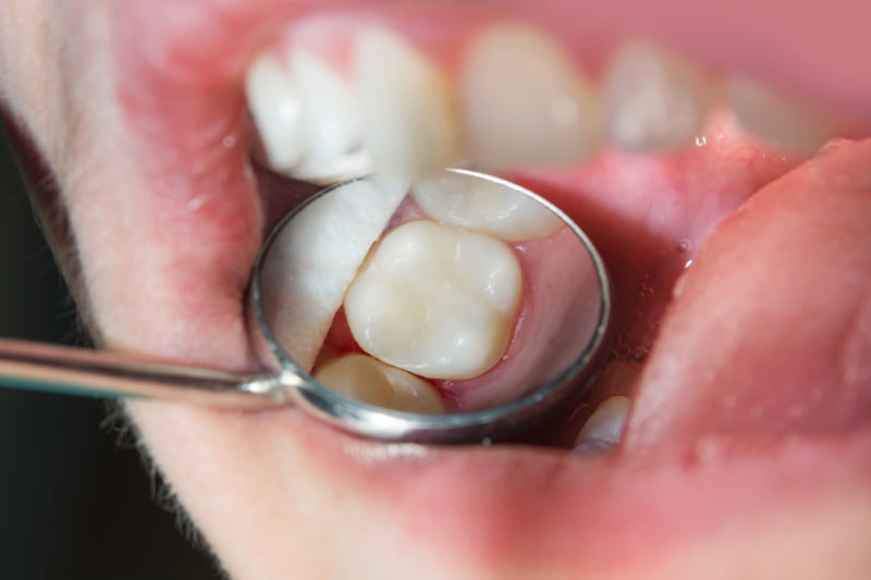 Facetas de porcelana: conhece os prós e contras?