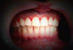 Estudo confirma que doença periodontal pode causar hipertensão