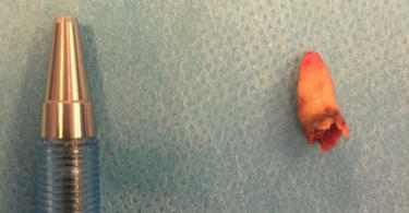 Médicos descobrem dente retido na cavidade nasal de paciente