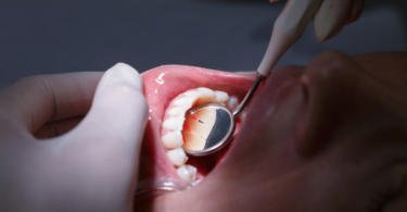 Investigadores desenvolvem nova técnica para regenerar tecido gengival e prevenir perda dentária