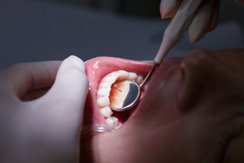 Investigadores desenvolvem nova técnica para regenerar tecido gengival e prevenir perda dentária