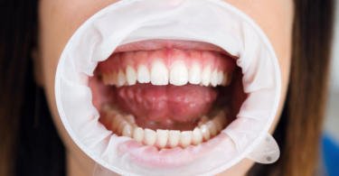 Cientistas criam microrobôs que eliminam placa bacteriana