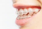 Aparelho dentário