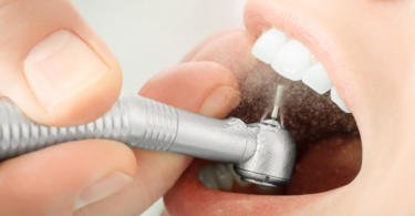 Investigadores criam material para restaurações dentárias com propriedades antibacterianas