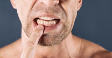 doença periodontal