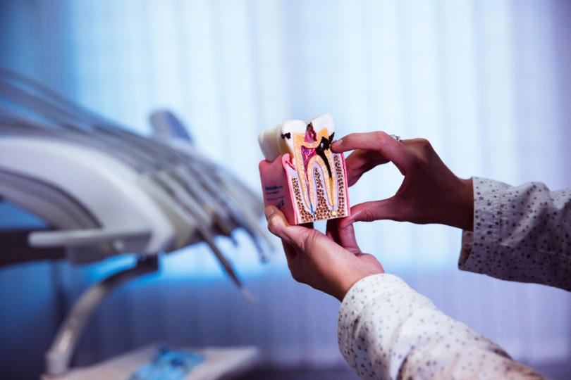 modelo de dente com cárie