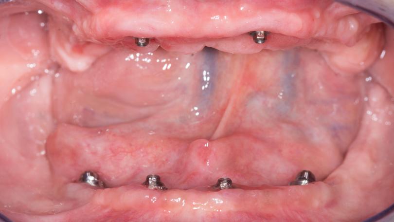 Carga imediata bimaxilar em paciente com defeito ósseo e exposição gengival posterior