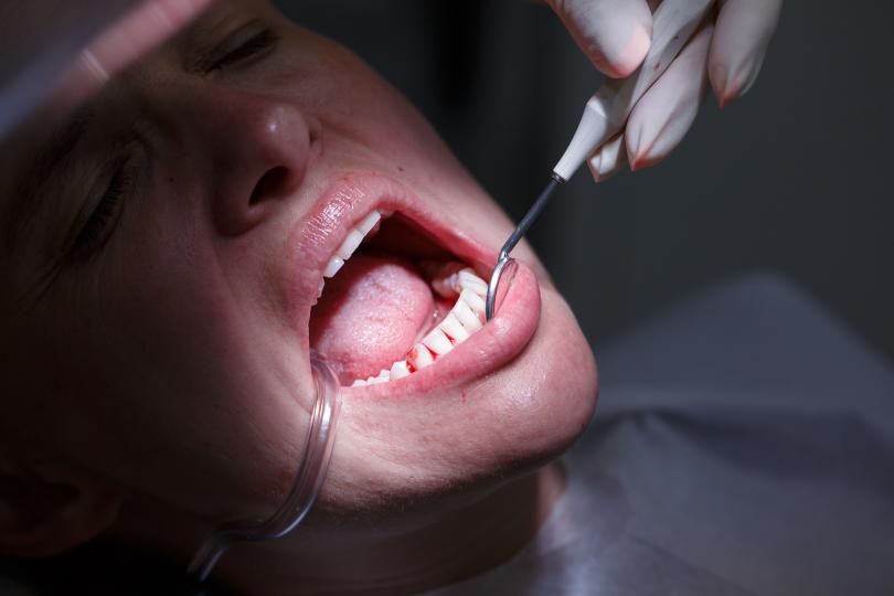 Periodontite pode mesmo aumentar o risco de doenças cardiovasculares