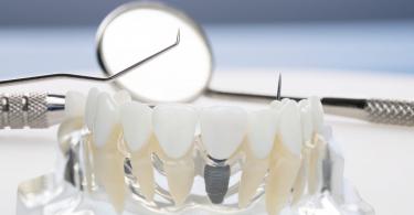 restaurações coroas